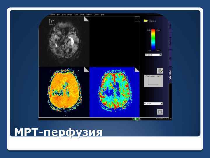 МРТ-перфузия 