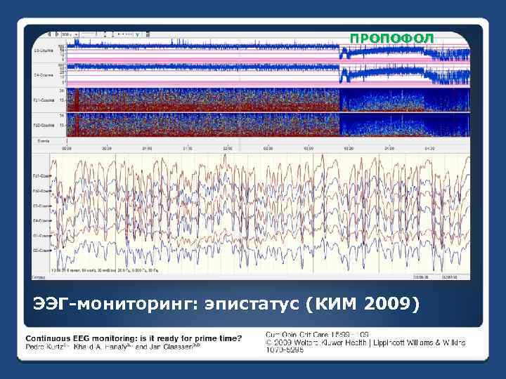 Ээг мониторинг. Эпистатус на ЭЭГ. Монитор ЭЭГ. Электроэнцефалографического мониторинга.