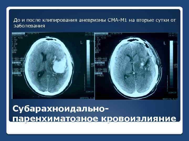 До и после клипирования аневризмы СМА-М 1 на вторые сутки от заболевания Субарахноидальнопаренхиматозное кровоизлияние