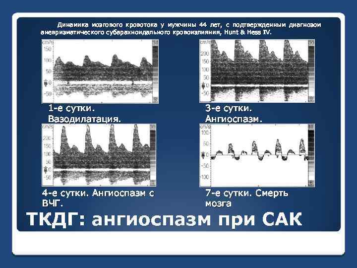 Динамика мозгового кровотока у мужчины 44 лет, с подтвержденным диагнозом аневризматического субарахноидального кровоизлияния, Hunt