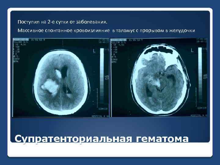 Поступил на 2 -е сутки от заболевания. Массивное спонтанное кровоизлияние в таламус с прорывом