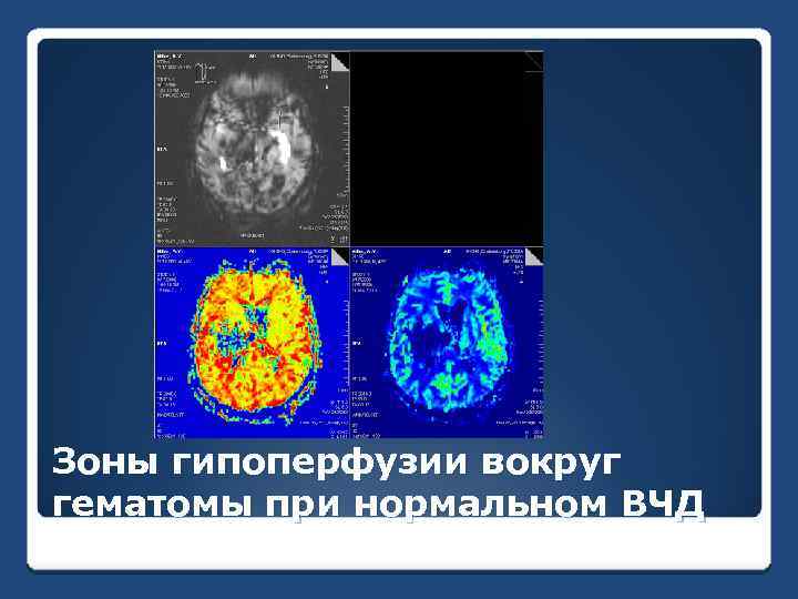 Зоны гипоперфузии вокруг гематомы при нормальном ВЧД 