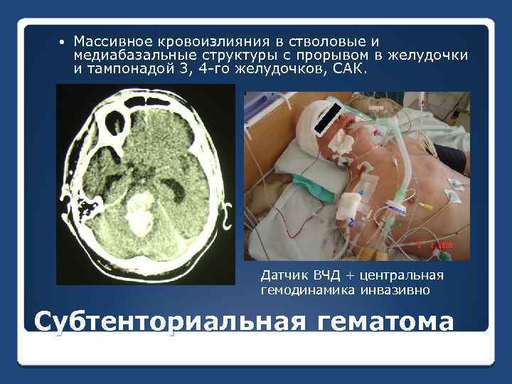  Массивное кровоизлияния в стволовые и медиабазальные структуры с прорывом в желудочки и тампонадой