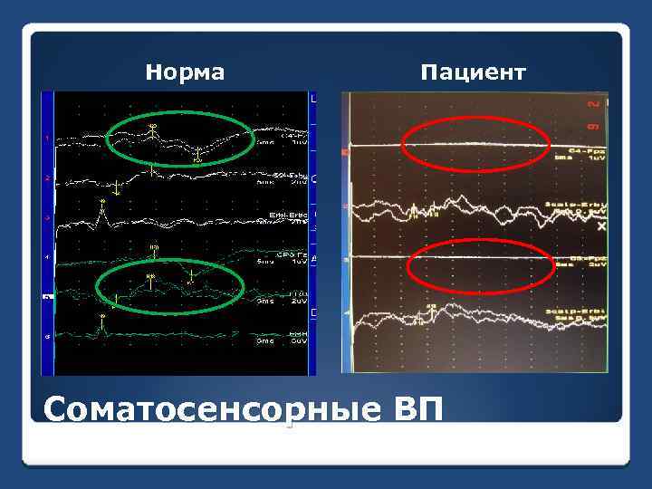 Норма Пациент Соматосенсорные ВП 