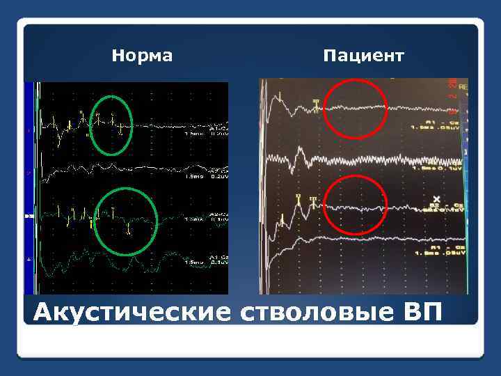 Норма Пациент Акустические стволовые ВП 
