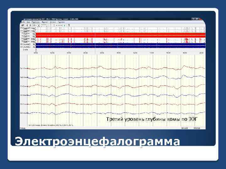 Третий уровень глубины комы по ЭЭГ Электроэнцефалограмма 