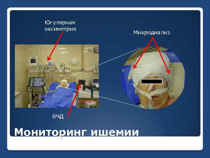 Югулярная оксиметрия Микродиализ ВЧД Мониторинг ишемии 