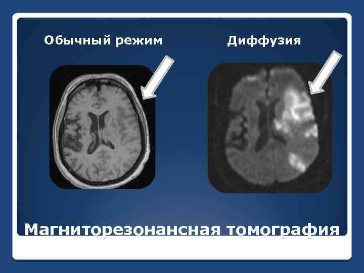 Обычный режим Диффузия Магниторезонансная томография 