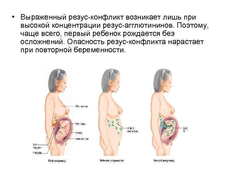  • Выраженный резус-конфликт возникает лишь при высокой концентрации резус-агглютининов. Поэтому, чаще всего, первый