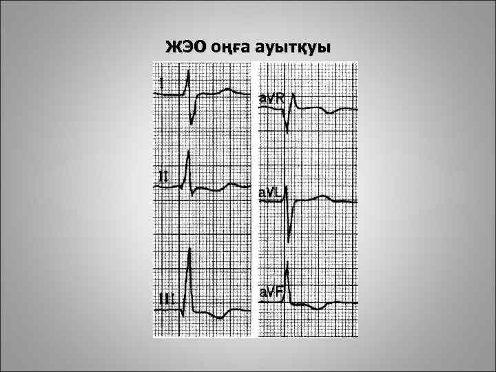 ЖЭО оңға ауытқуы 