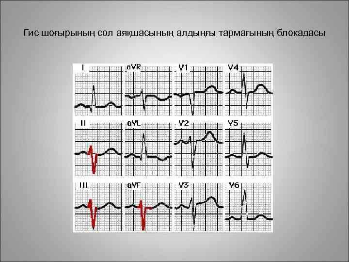 Гис шоғырының сол аяқшасының алдыңғы тармағының блокадасы 