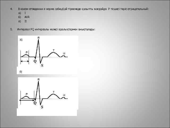 4. 5. В каком отведении в норме зубецҚай тіркемеде қалыпты жағдайда Р тісшесі теріс
