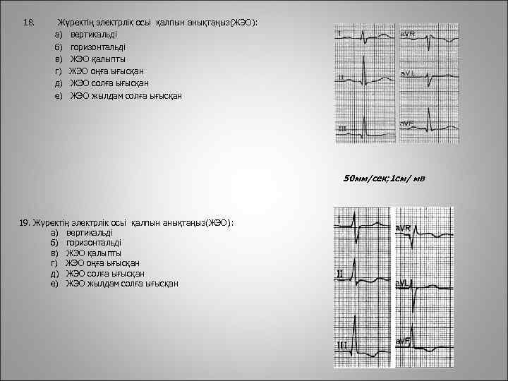 18. Жүректің электрлік осьі қалпын анықтаңыз(ЖЭО): а) вертикальді б) горизонтальді в) ЖЭО қалыпты г)