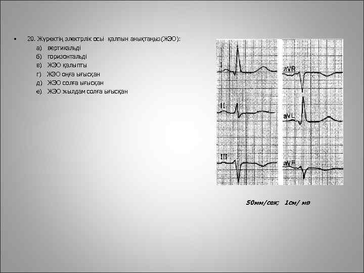  • 20. Жүректің электрлік осьі қалпын анықтаңыз(ЖЭО): а) вертикальді б) горизонтальді в) ЖЭО