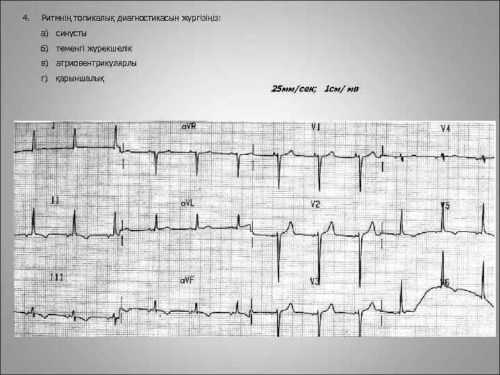 4. Ритмнің топикалық диагностикасын жүргізіңіз: а) синусты б) төменгі журекшелік в) атриовентрикулярлы г) қарыншалық