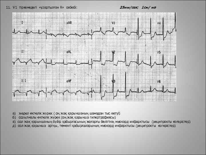 11. V 1 тіркемедегі «ұзартылған R» себебі: а) б) в) д) 25 мм/сек; 1