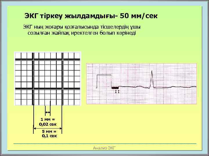 ЭКГ тіркеу жылдамдығы- 50 мм/сек ЭКГ ның жоғары қозғалысында тісшелердің ұшы созылған жайпақ иректелген