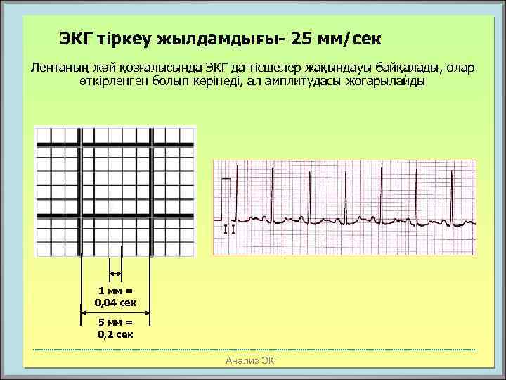 ЭКГ тіркеу жылдамдығы- 25 мм/сек Лентаның жәй қозғалысында ЭКГ да тісшелер жақындауы байқалады, олар