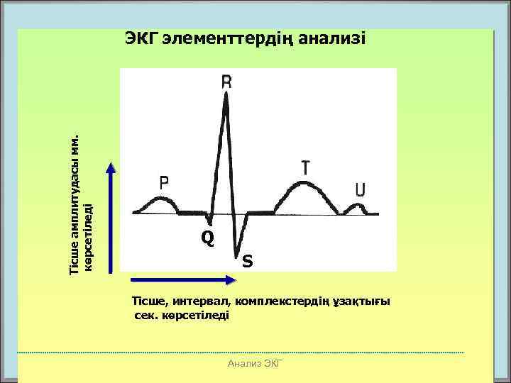 Тісше амплитудасы мм. көрсетіледі ЭКГ элементтердің анализі Q S Тісше, интервал, комплекстердің ұзақтығы сек.