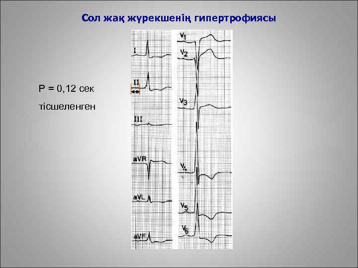 Сол жақ жүрекшенің гипертрофиясы Р = 0, 12 сек тісшеленген 