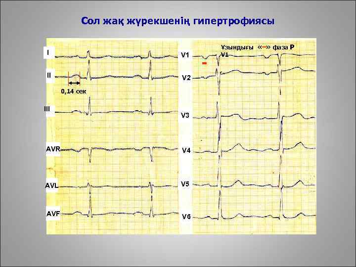 Сол жақ жүрекшенің гипертрофиясы I V 1 II V 2 0, 14 сек III