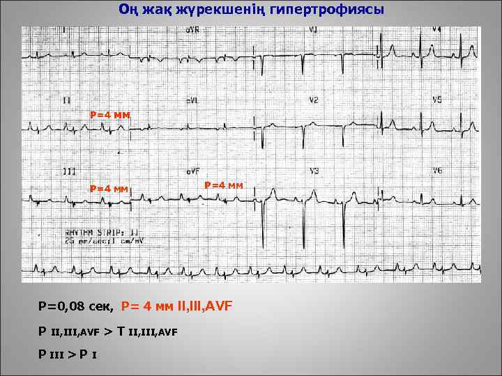 Оң жақ жүрекшенің гипертрофиясы Р=4 мм Р=0, 08 сек, Р= 4 мм II, III,