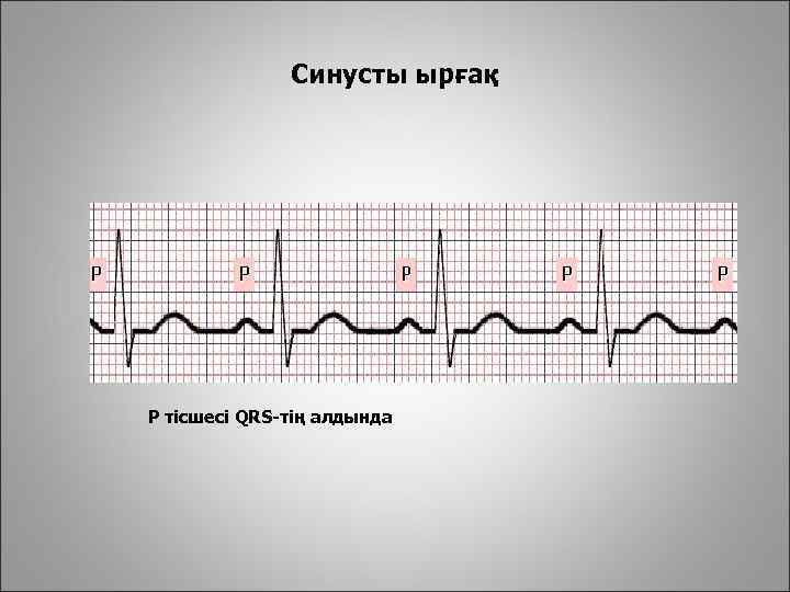 Синусты ырғақ Р тісшесі QRS-тің алдында 