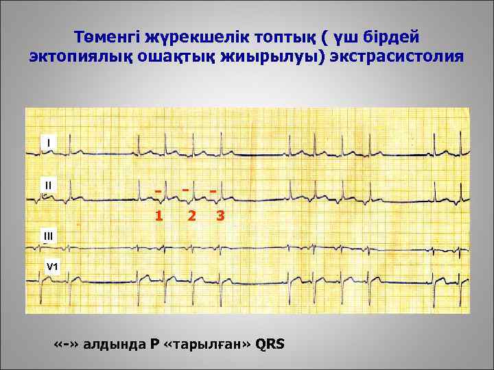 Төменгі жүрекшелік топтық ( үш бірдей эктопиялық ошақтық жиырылуы) экстрасистолия I - - -