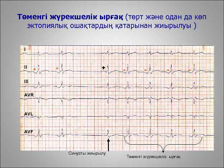 Төменгі жүрекшелік ырғақ (төрт және одан да көп эктопиялық ошақтардың қатарынан жиырылуы ) I