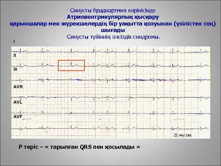 Синусты брадиартмия көрінісінде Атриовентрикулярлық қысқару қарыншалар мен жүрекшелердің бір уақытта қозуынан (үзілістен соң) шығады