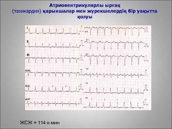 Атриовентрикулярлы ырғақ (тахикардия) қарыншалар мен жүрекшелердің бір уақытта қозуы I V 1 II III