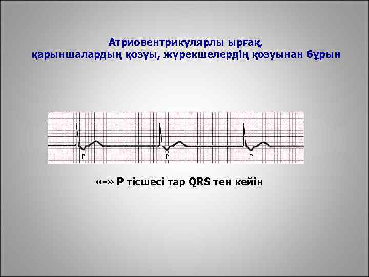 Атриовентрикулярлы ырғақ, қарыншалардың қозуы, жүрекшелердің қозуынан бұрын «-» Р тісшесі тар QRS тен кейін