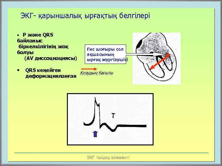 ЭКГ- қарыншалық ырғақтың белгілері • Р және QRS байланыс біркелкілігінің жоқ болуы (AV диссоциациясы)