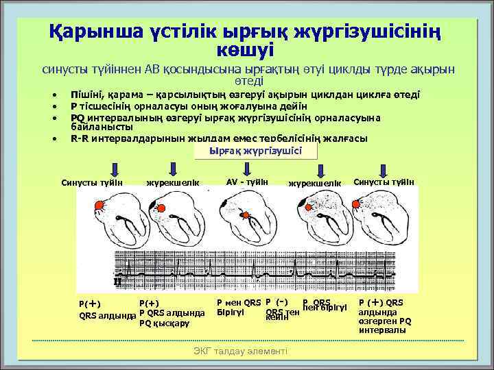 Қарынша үстілік ырғық жүргізушісінің көшуі синусты түйіннен АВ қосындысына ырғақтың өтуі циклды түрде ақырын