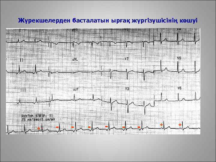 Жүрекшелерден басталатын ырғақ жүргізушісінің көшуі + - - - + + 