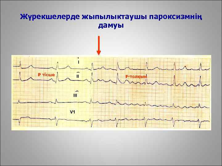 Жүрекшелерде жыпылыктаушы пароксизмнің дамуы I Р тісше II III V 1 F-толқын 