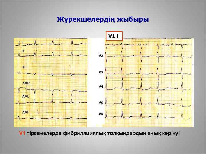 Жүрекшелердің жыбыры V 1 ! I II V 2 III V 3 AVR V