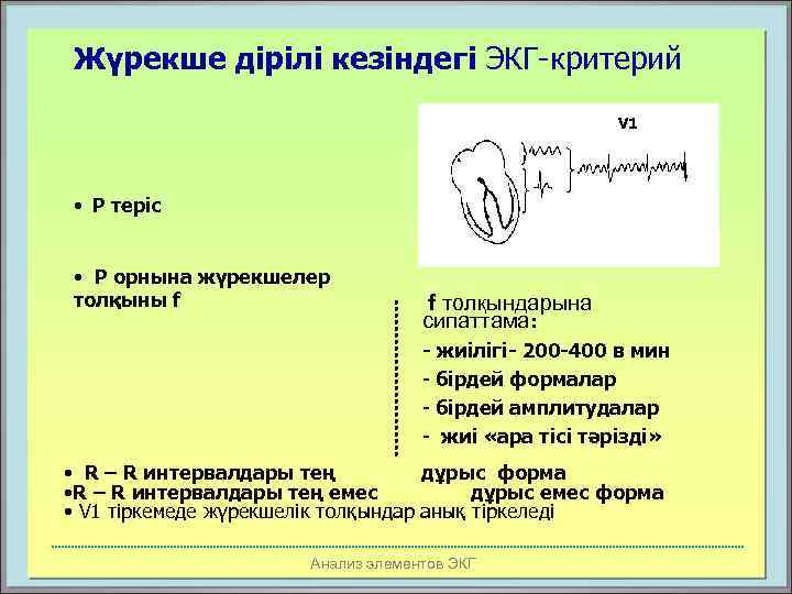 Жүрекше дірілі кезіндегі ЭКГ-критерий V 1 • Р теріс • Р орнына жүрекшелер толқыны