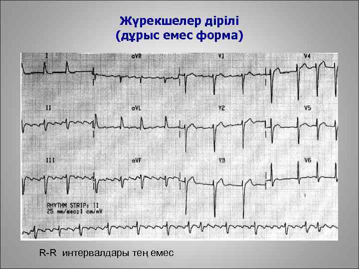Жүрекшелер дірілі (дұрыс емес форма) R-R интервалдары тең емес 