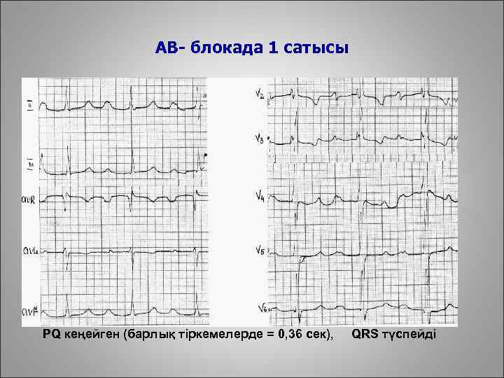 АВ- блокада 1 сатысы PQ кеңейген (барлық тіркемелерде = 0, 36 сек), QRS түспейді