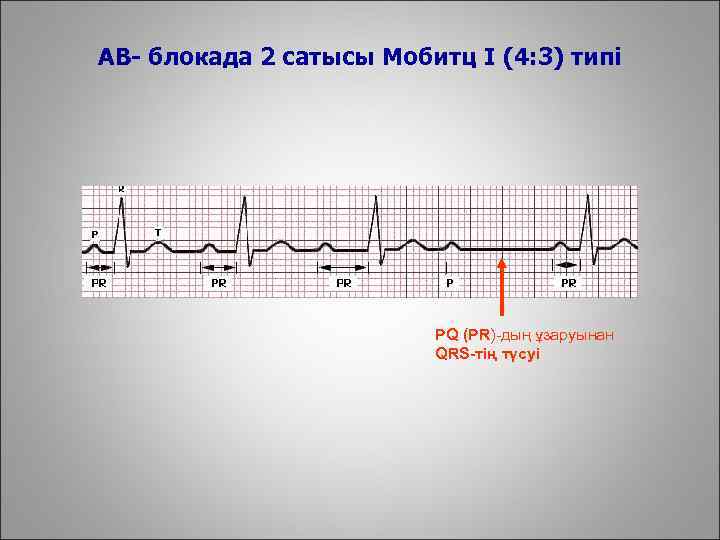 AВ- блокада 2 сатысы Мобитц I (4: 3) типі PQ (PR)-дың ұзаруынан QRS-тің түсуі