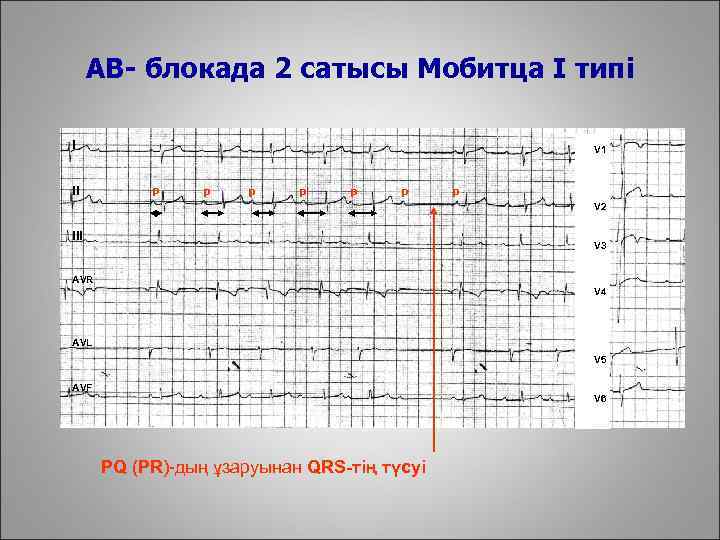 AВ- блокада 2 сатысы Мобитца I типі I II V 1 p p p