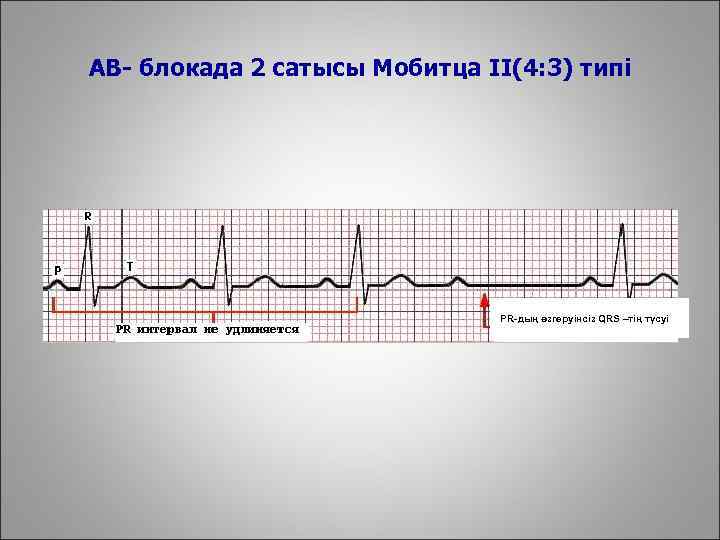 AВ- блокада 2 сатысы Мобитца II(4: 3) типі PR-дың өзгеруінсіз QRS –тің түсуі 