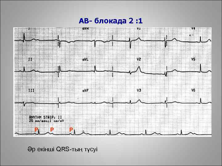 АВ- блокада 2 : 1 Р Р Р Әр екінші QRS-тың түсуі 