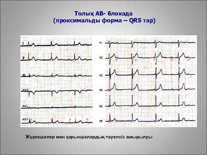 Толық АВ- блокада (проксимальды форма – QRS тар) I V 1 II V 2