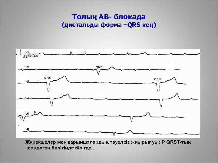 Толық АВ- блокада (дистальды форма –QRS кең) V 1 p V 2 p QRS