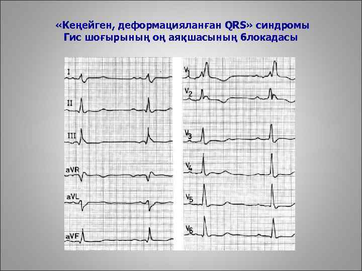  «Кеңейген, деформацияланған QRS» синдромы Гис шоғырының оң аяқшасының блокадасы 