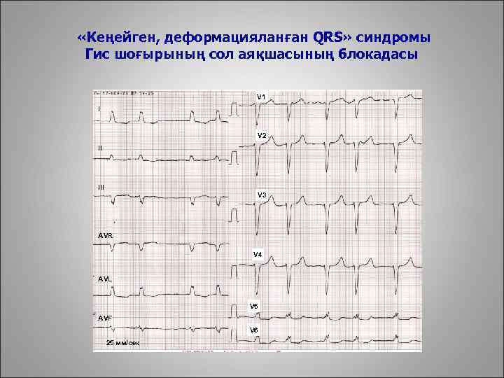  «Кеңейген, деформацияланған QRS» синдромы Гис шоғырының сол аяқшасының блокадасы V 1 I V
