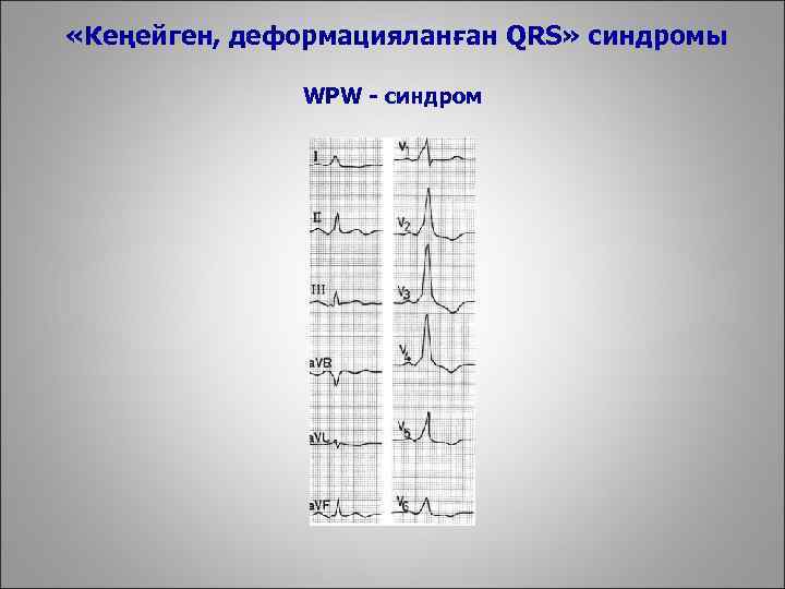  «Кеңейген, деформацияланған QRS» синдромы WPW - синдром 