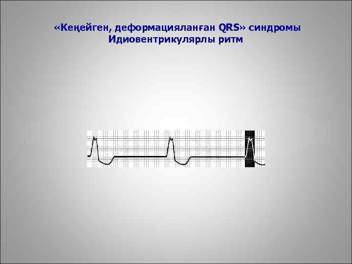  «Кеңейген, деформацияланған QRS» синдромы Идиовентрикулярлы ритм 